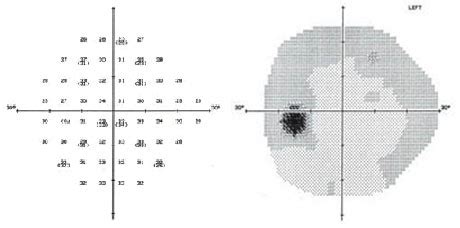 visual test eye drops and uv|how to prepare for visual field test.